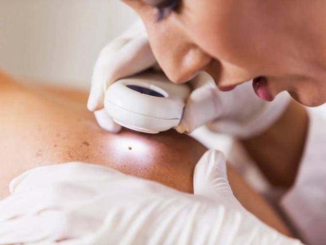 Common Myths about Mole Removal in Dubai