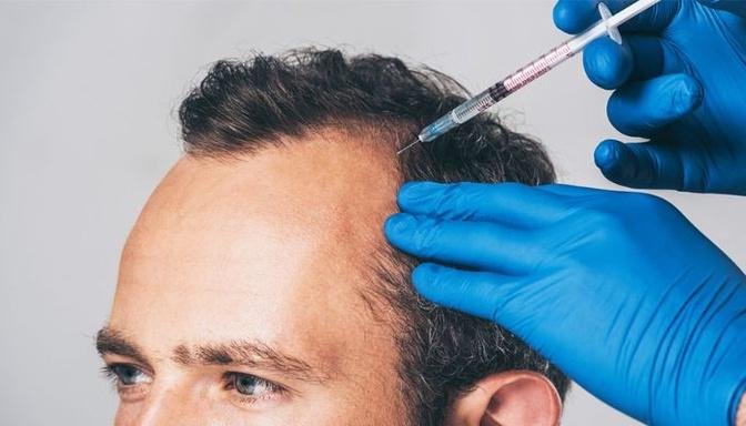 The Evolution of PRP Hair Therapy in Dubai