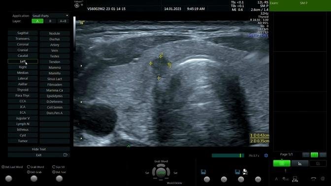 Nodule of Thyroid TIRADS 5 Ultrasound