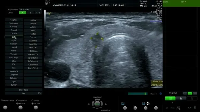 Nodule of Thyroid TIRADS 5 Ultrasound