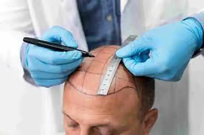 The Power of Precision: Scalp Micropigmentation in Dubai