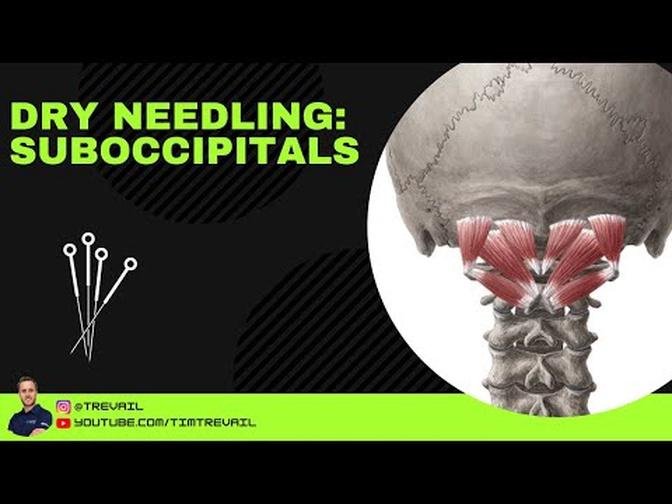 Dry Needling: Suboccipitals