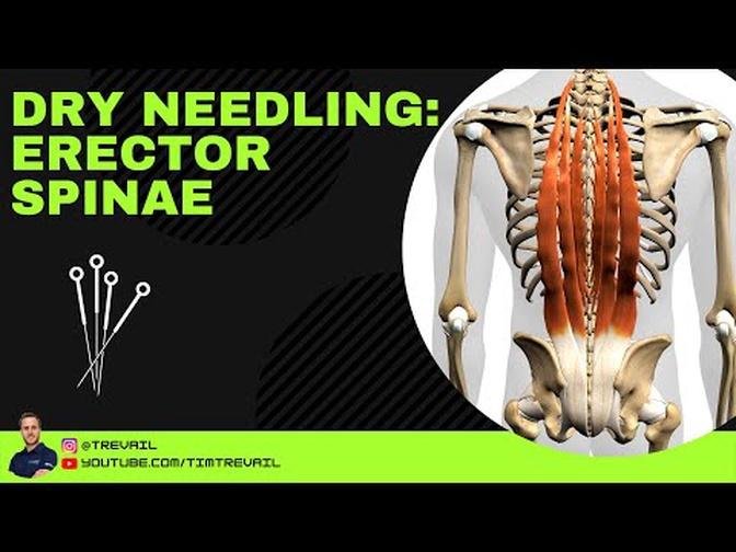 Dry Needling: Erector Spinae