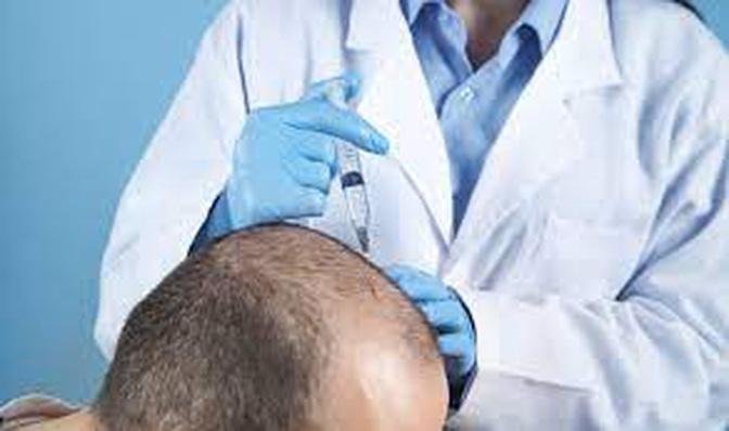 The Future of Hair Loss Treatment: ALook at ACell PRP Therapy