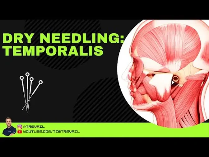 Dry Needling: Temporalis