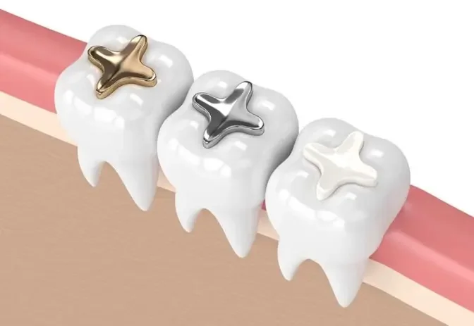 Dental Filling Alternatives: Exploring Options Available in Dubai