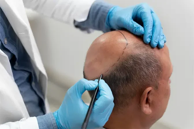 Reclaim Your Confidence: Scalp Micropigmentation in Dubai