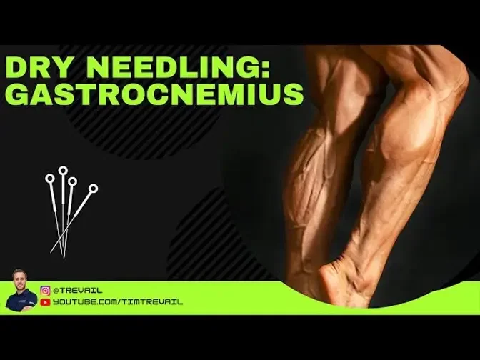 Dry Needling: Gastrocnemius