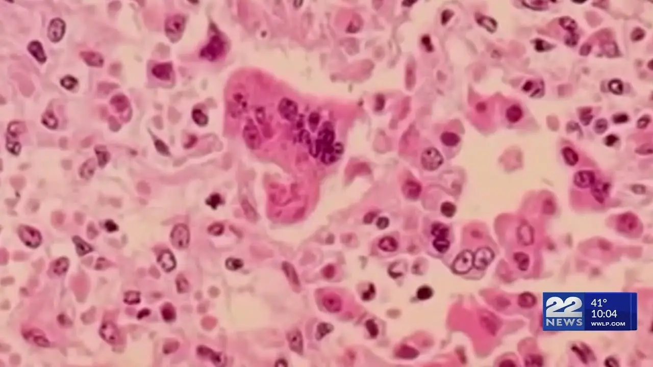 Measles cases on the rise in New England, prompting health concerns