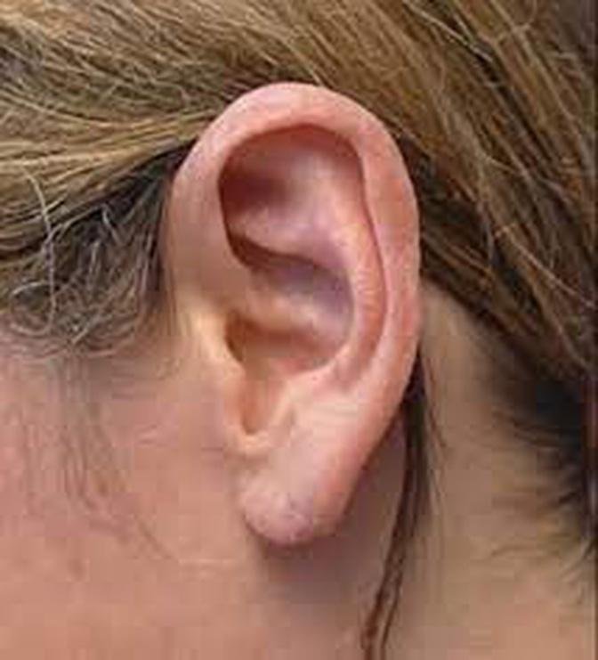 Is Earlobe Correction Surgery in Dubai stretching permanent?
