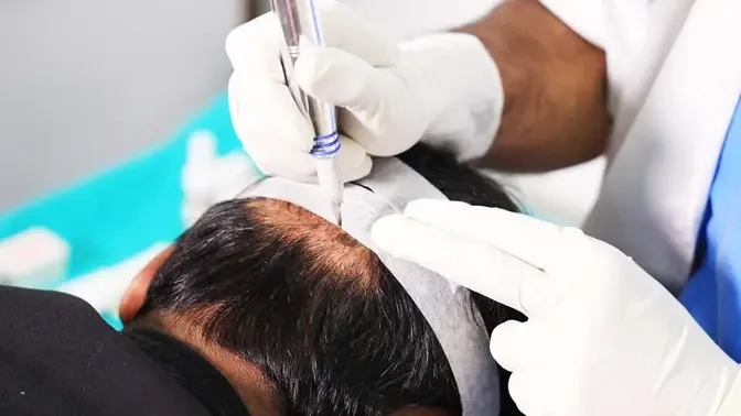 Dubai's Top Scalp Micropigmentation Clinics Revealed