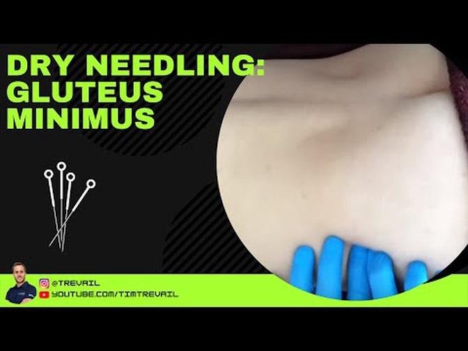 Dry Needling: Gluteus Minimus