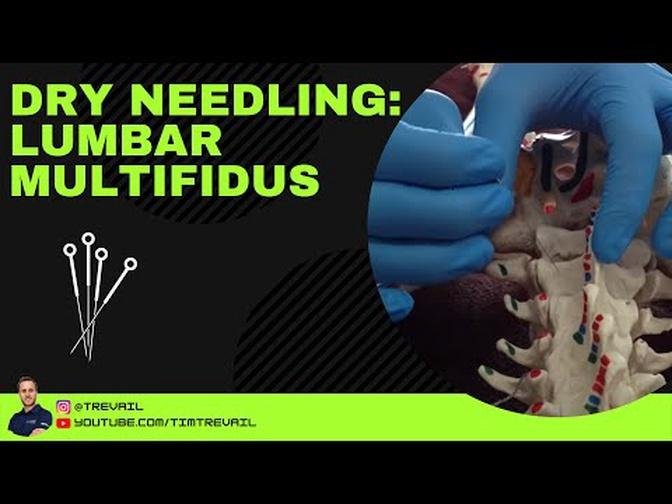 Dry Needling: Multifidus