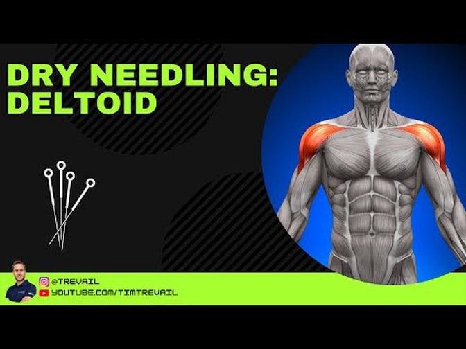Dry Needling: Deltoid