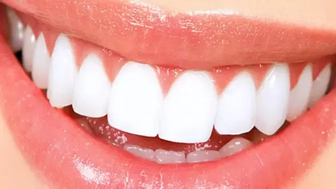 Dubai Smile Makeover: Veneers on a Budget?