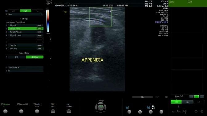 Appendicitis Ultrasound