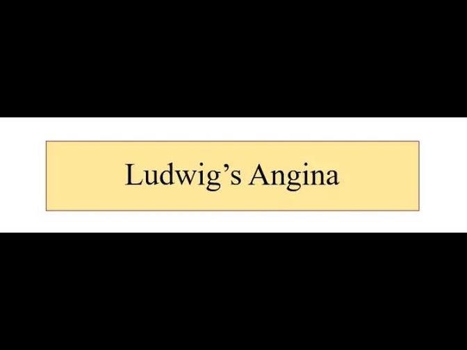 Ludwig's Angina