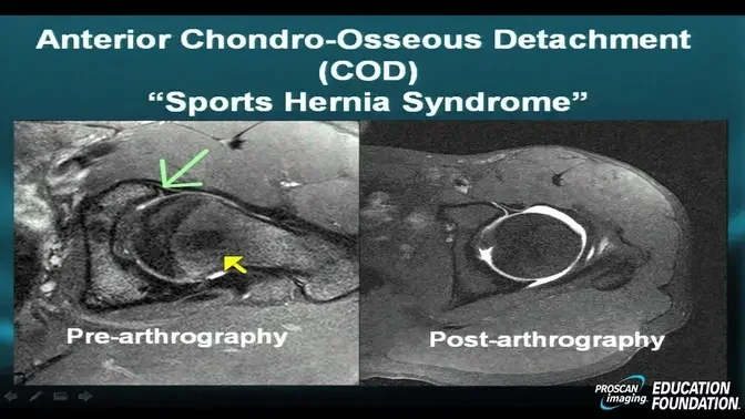 MRI Online Hip Pathology Part II