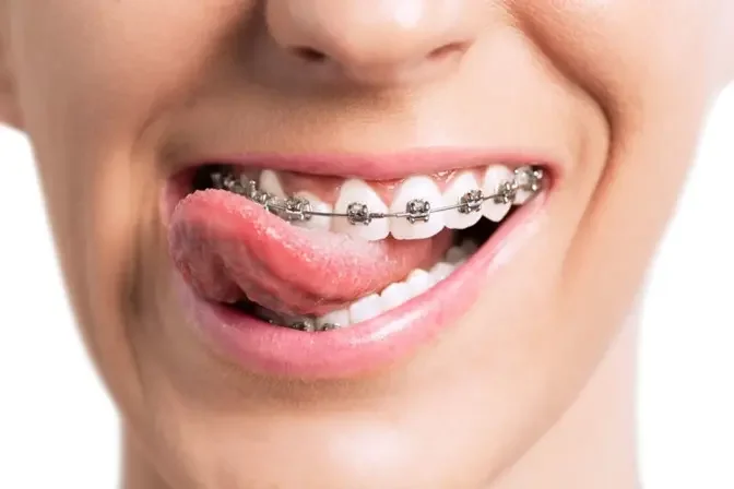 Maintaining Results: Post-Treatment Care Tips from Dubai Orthodontists