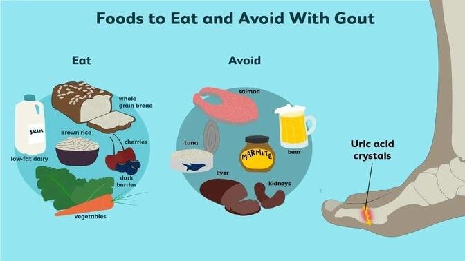 Best & Worst Foods to Eat with Gout | Reduce Risk of Gout Attacks and ...