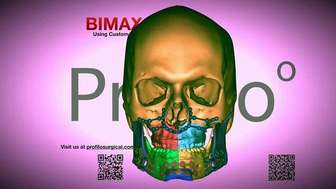 Before and after jaw surgery with BIMAX (music added)