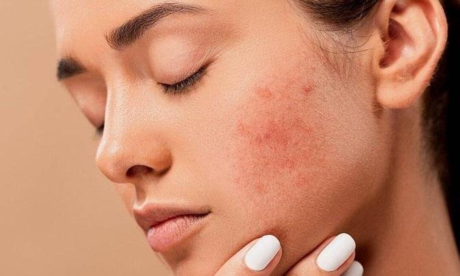 Invest in Clearer, Calmer Skin: Dubai Rosacea Treatment?