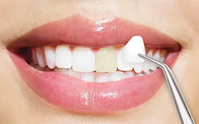 Where Can I Find the Best Deals on Composite Veneers in Dubai?