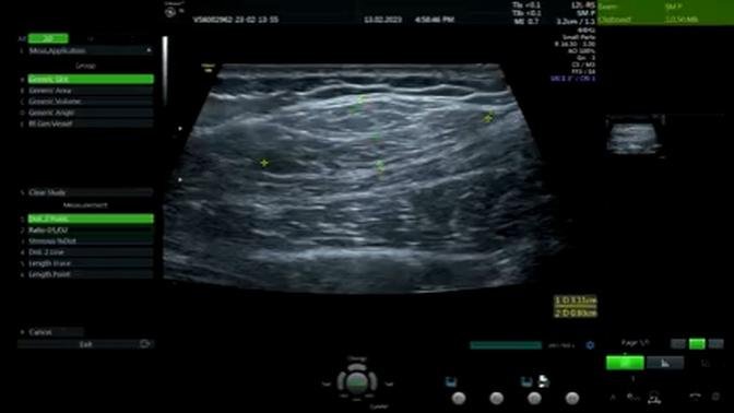 Lipoma Ultrasound