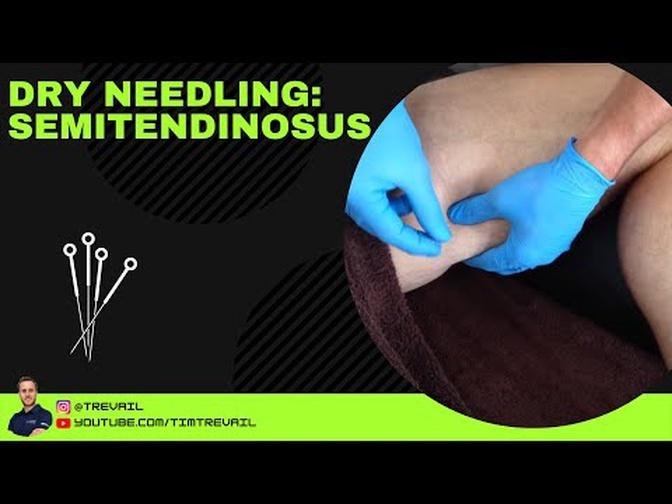Dry Needling: Semitendinosus