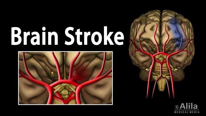 Brain Stroke, Types of, Causes, Pathology, Symptoms, Treatment and Prevention, Animation