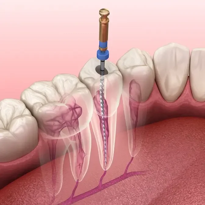 Enhancing Oral Health with Root Canal Treatment in Dubai