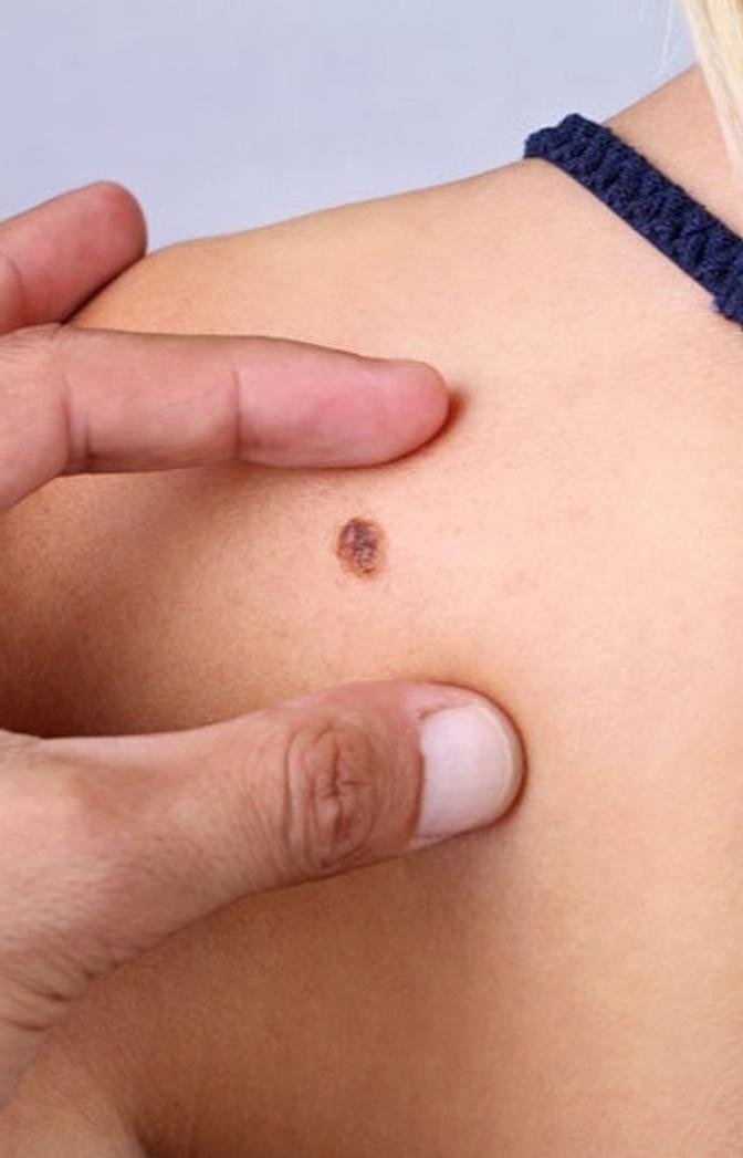 "Understanding the Different Types of Skin Tag Removal Tools"