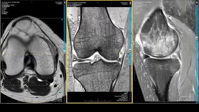 Knee MRI - Meniscocapsular Separation and Subchondral Insufficiency ...