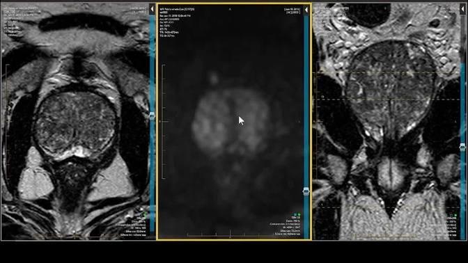 Prostate MRI — PI-RADS 2 | Videos | MRI Online | Gan Jing World