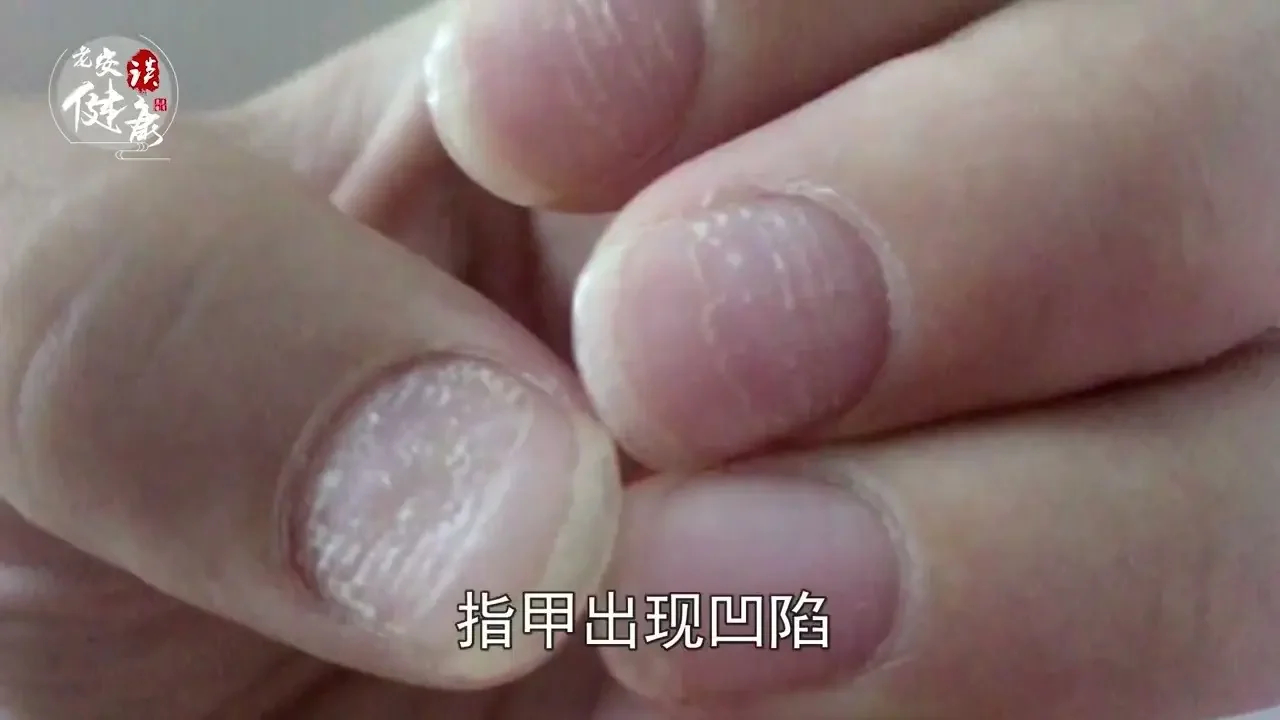 指甲上有斑或不平｜白斑：消化不良、缺鈣、營養不足。斷裂：缺鈣、缺蛋白。凹或皺：牛皮癬、關節炎。縱溝甲：過勞，神經衰弱。橫溝甲：營養不良，熬夜、吃飯不規律。黑斑甲：腫瘤、壞疽、血液循環障礙【老安談健康】