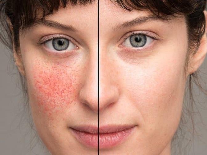 Rosacea Redness Reduction in Dubai: A Comprehensive Guide to Effective Treatments?