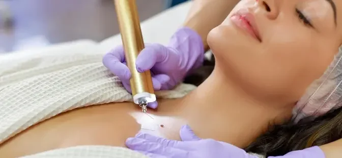 Which is the best mole removal method in Dubai?