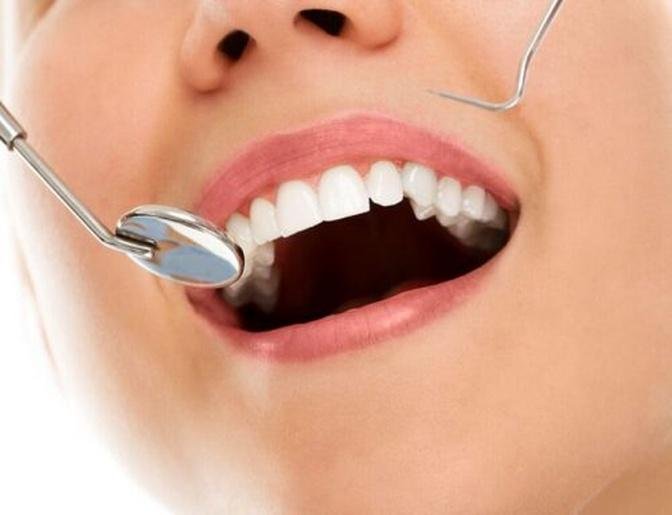 Same-Day Tooth Fillings in Dubai: Cost & Benefits