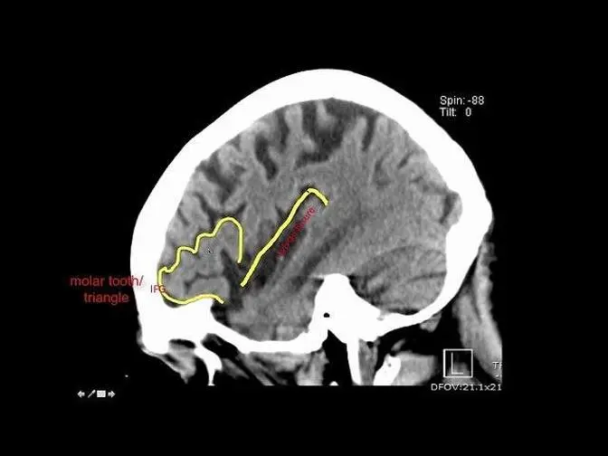 Introduction to Brain Surface Anatomy