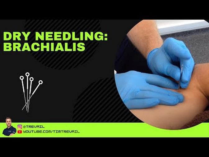 Dry Needling: Brachialis