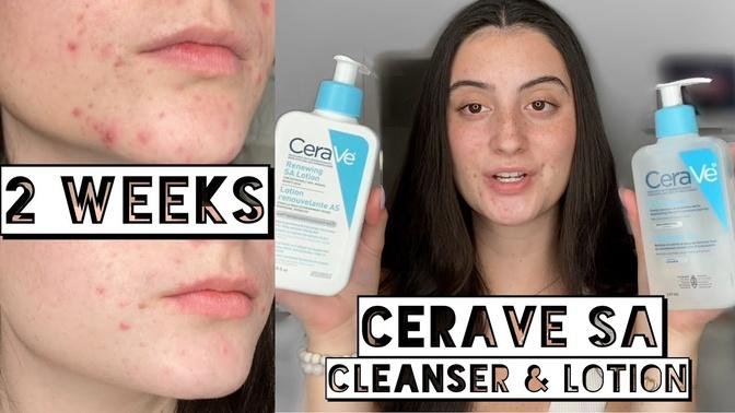 TESTING CERAVE SA CLEANSER & LOTION ON MY DRY ACNE SKIN FOR 2 WEEKS