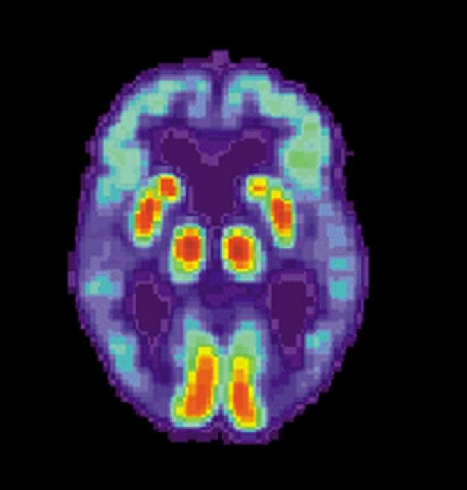 Alzheimer’s May Have Once Spread From Person to Person