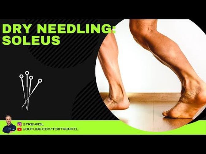 Dry Needling: Soleus
