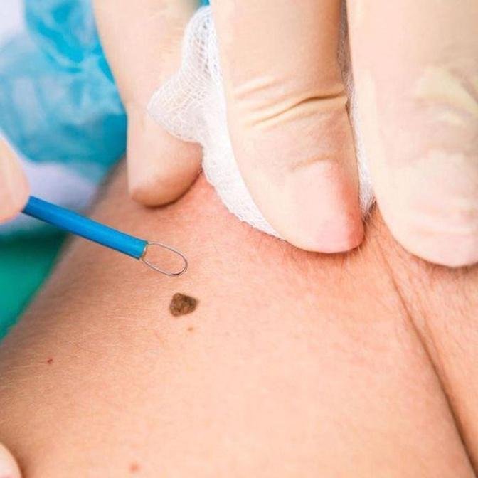 Beware of Hidden Costs: Ask These Questions Before Mole Removal in Dubai