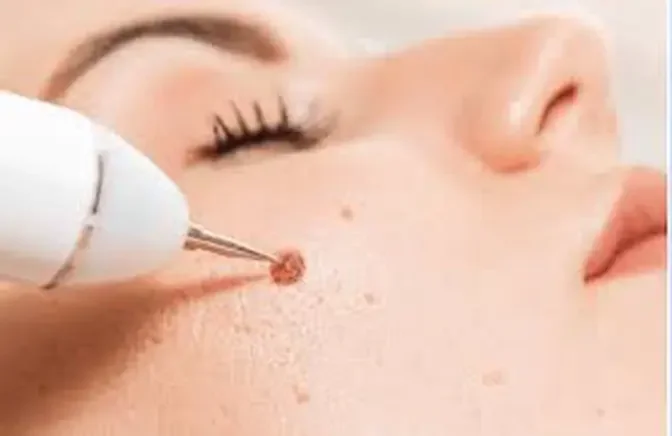 "Smooth Skin Journey: Navigating Mole Removal Solutions"