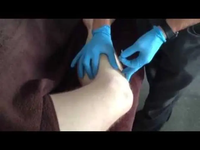 Dry Needling: Popliteus