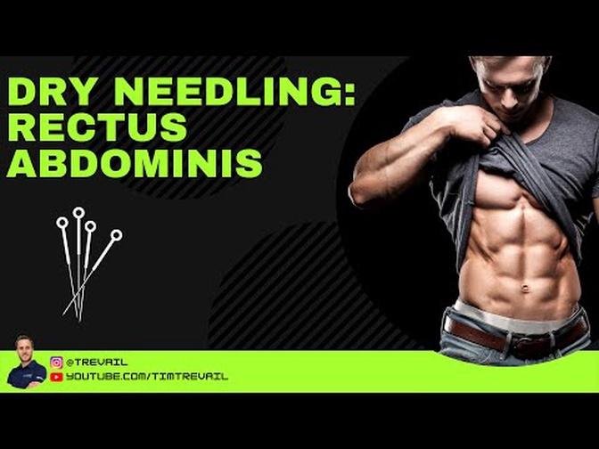 Dry Needling: Rectus Abdominis