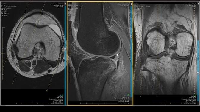 Knee MRI - Case Review: Twisting Injury