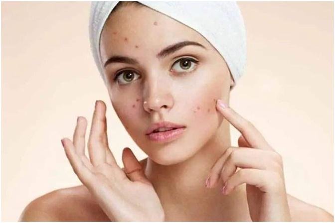 The Impact of Pimples Treatment on Your Health