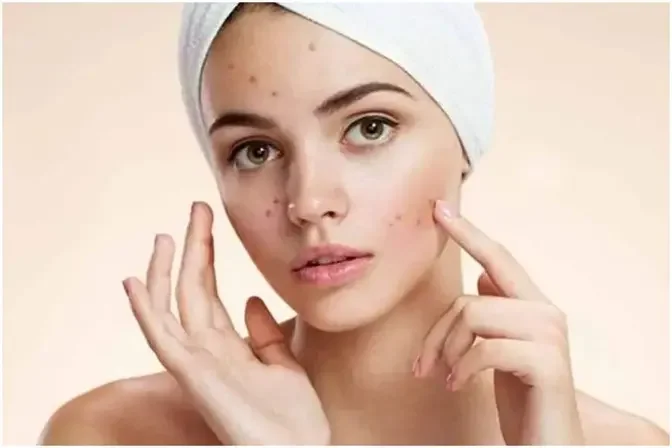 The Impact of Pimples Treatment on Your Health